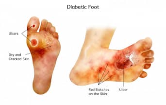 diabetic charcot foot